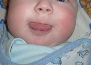 Малышу 7,5 месяцев покраснели щёчки