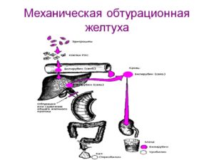 Механическая желтуха