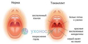 Можно ли купаться сразу после температуры и боли в горле