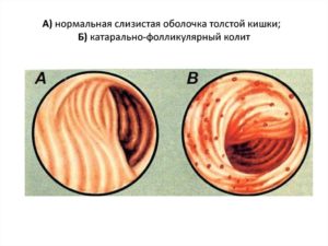 Катаральный колит