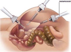 Болит левый бок после лапароскопии