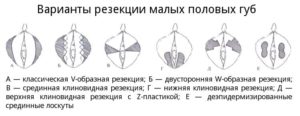 Большие половые губы, интересует пластика