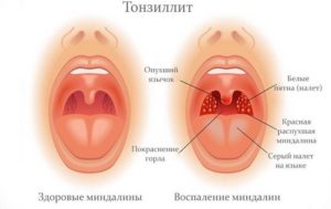 Болит горло, хронический тонзиллит и гайморит