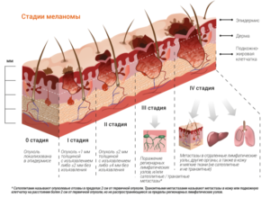 Меланома стадия 1а
