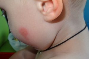 Красное уплотнение на щеке у ребенка
