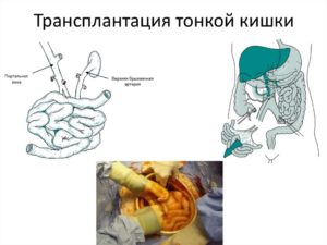 Пересадка тонкой кишки новорожденному