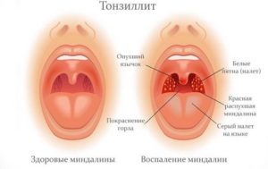 Болит горло два месяца