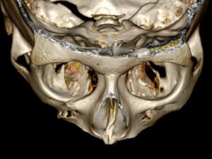 Перелом скуло-орбитального комплекса