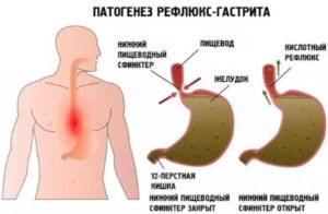 Лечение гастрита, рефлюкс-эзофагита, бульбита, бактерии