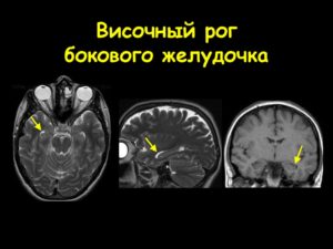 Киста и дилатация переднего рога желудочка