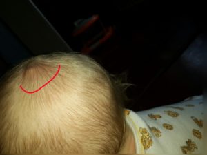 Красные пятна с жёлтой коркой у ребенка на голове