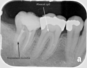 Болит запломбированный зуб