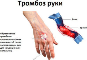 Болит правая рука с внутренней стороны по ходу вены