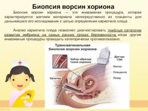 Как расшифровать кариотип плода 45[2]/46[7] делали биопсию хориона