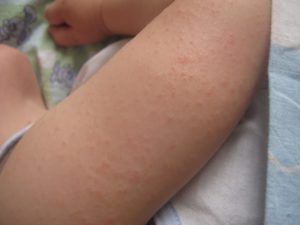 Крупная сыпь на руках и ногах у ребёнка с температурой