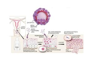 Планирование беременности при ВПЧ