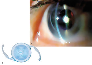 Контактные линзы при катаракте