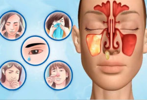 Болит пазуха носа, без насморка