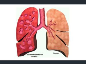 Бронхоэктатическая болезнь