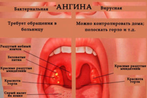 Красное горло и боли во рту у ребёнка