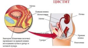 Боль в мочевом пузыре и пояснице