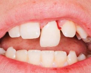 Болит и шатается передний зуб после удара