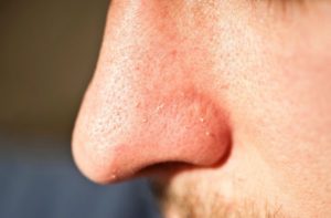 Как справится с жиром на носу?