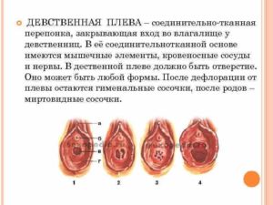 Килевидная девственная плева