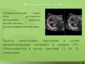 Лечение при вентрикуломегалии