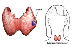 Киста и узел щитовидной железы