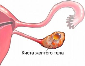 Киста желтого тела, очень болит