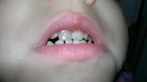 Болит и шатается передний зуб после удара