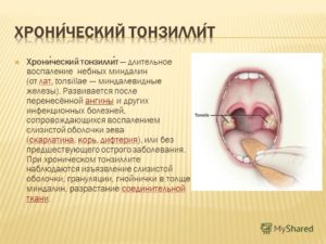 Хронический тонзиллит. Температура 37, просыпаюсь в мокром поту