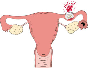 Как пережить внематочную беременность?