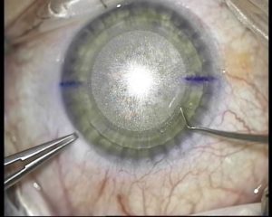 Как улучшится зрение после снятия швов с глаз