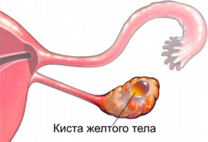 Киста желтого тела эко