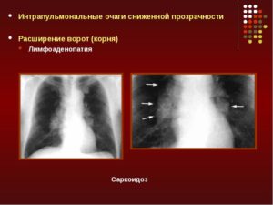 Лимфоаденопатия средостения, очаговые поражения лёгких