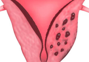 Коричневые выделения до месячных, миома, эндометриоз