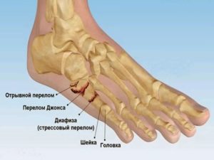 Перелом пятой плюсневой кости левой ноги у ребенка