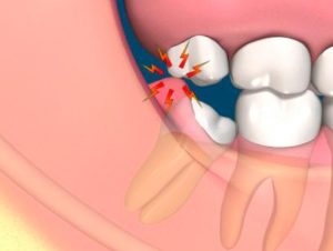Болит десна на месте удалённого зуба