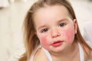 Контактный дерматит или аллергия у ребенка
