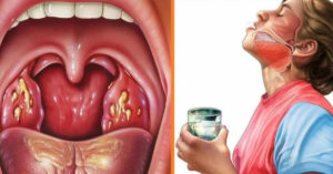 Болит горло, хронический тонзиллит и гайморит