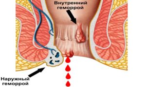 Болезненный синеватый шарик возле ануса