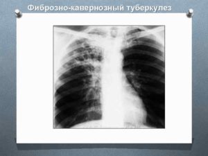 Был туберкулёз из за чего образовалась фиброза