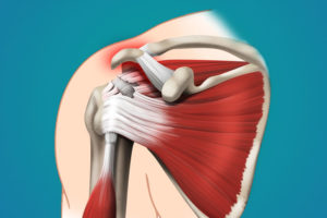 Болит плечо, плохо двигается, полный разрыв сухожилия надостной мышцы