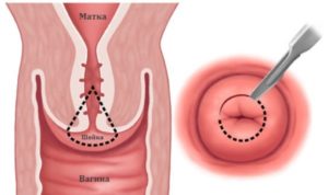 Кровянистые выделения после биопсии шейки матки