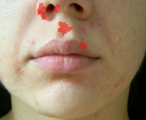 Красное пятно между верхней губой и носои б