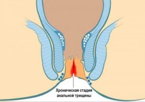 Кровь после родов при дефекации