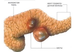 Киста поджелудочной железы