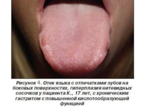 Боль в животе белый налет на язык